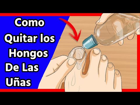 Remedio Casero Para Combatir Los hongos En Las Uñas