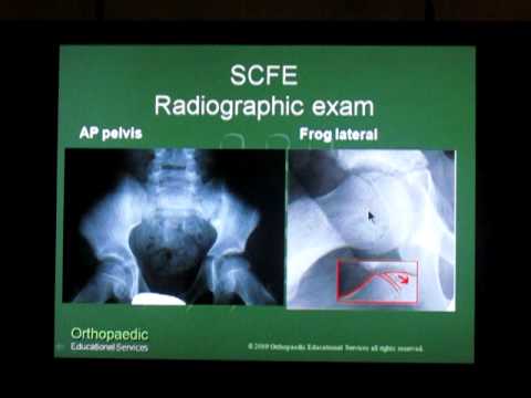 Slipped Capital Femoral Epiphysis (SCFE)