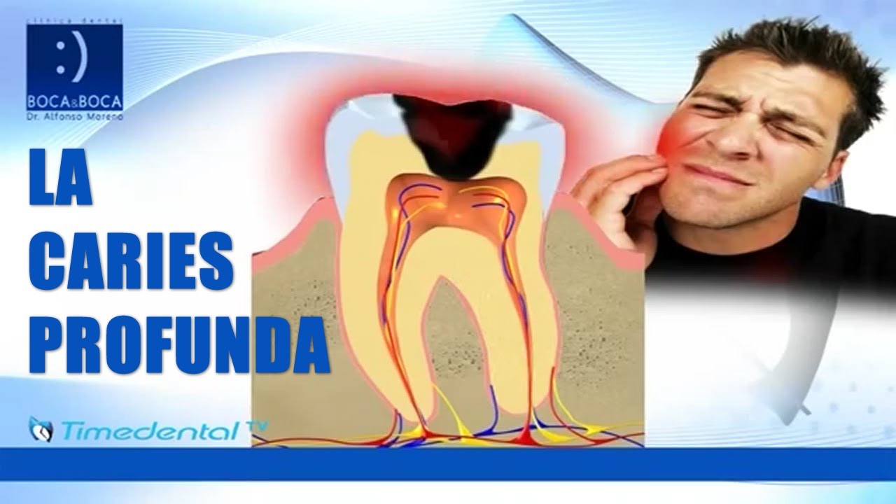 Watch ▷ 951 178 110 | Características y tratamiento de la caries profunda | Clínicas Boca&Boca | Málaga Now ▷ 951 178 110 | Características y tratamiento de la caries profunda | Clínicas Boca&Boca | Málaga