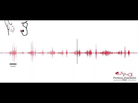Pleural Friction Rub