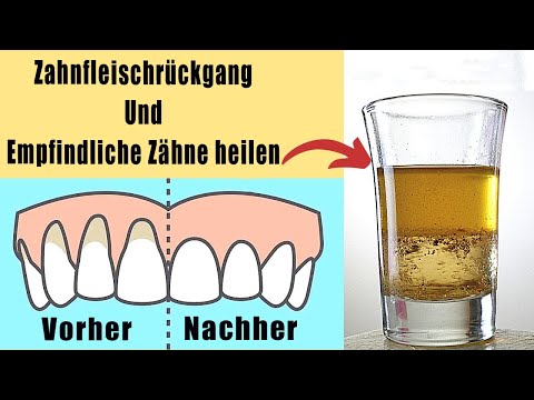 , title : 'Unglaubliches Mittel gegen Zahnfleischrückgang'