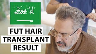 Saudi Arabia Patient FUT Hair Transplant Result