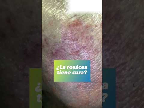 Rosácea y su tratamiento #cuidadodelapiel #enrojecimiento #rosacea #dermatologo #monterrey #onderm