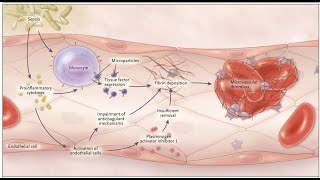Disseminated Intravascular Coagulation (DIC)