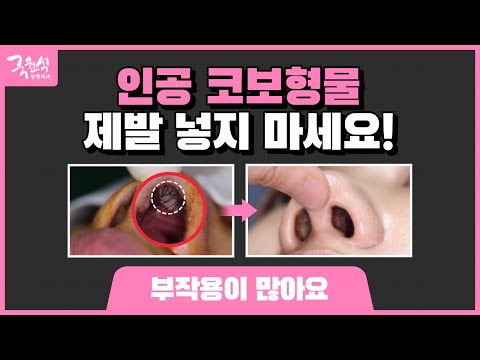 인공 코보형물 제발 넣지마세요!