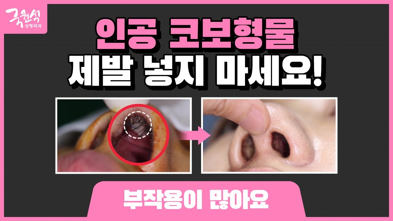 인공 코보형물 제발 넣지마세요! 썸네일