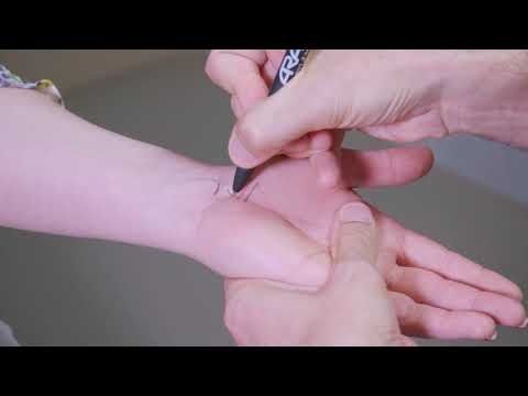 Carpal Tunnel Syndrome | Carpal Tunnel Surgery