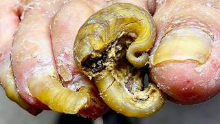72-Year-Old Patient's Toenails Are Curled Like Twists, Perfect Pedicure Process【Xue Yidao】
