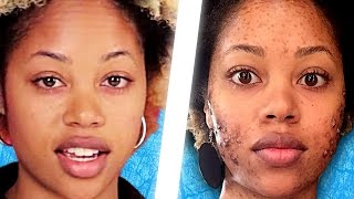 People Live With Acne For A Day