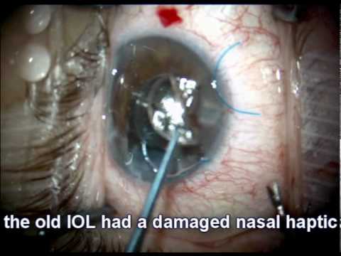Cataract Surgery - IOL Exchange With Iris Repair