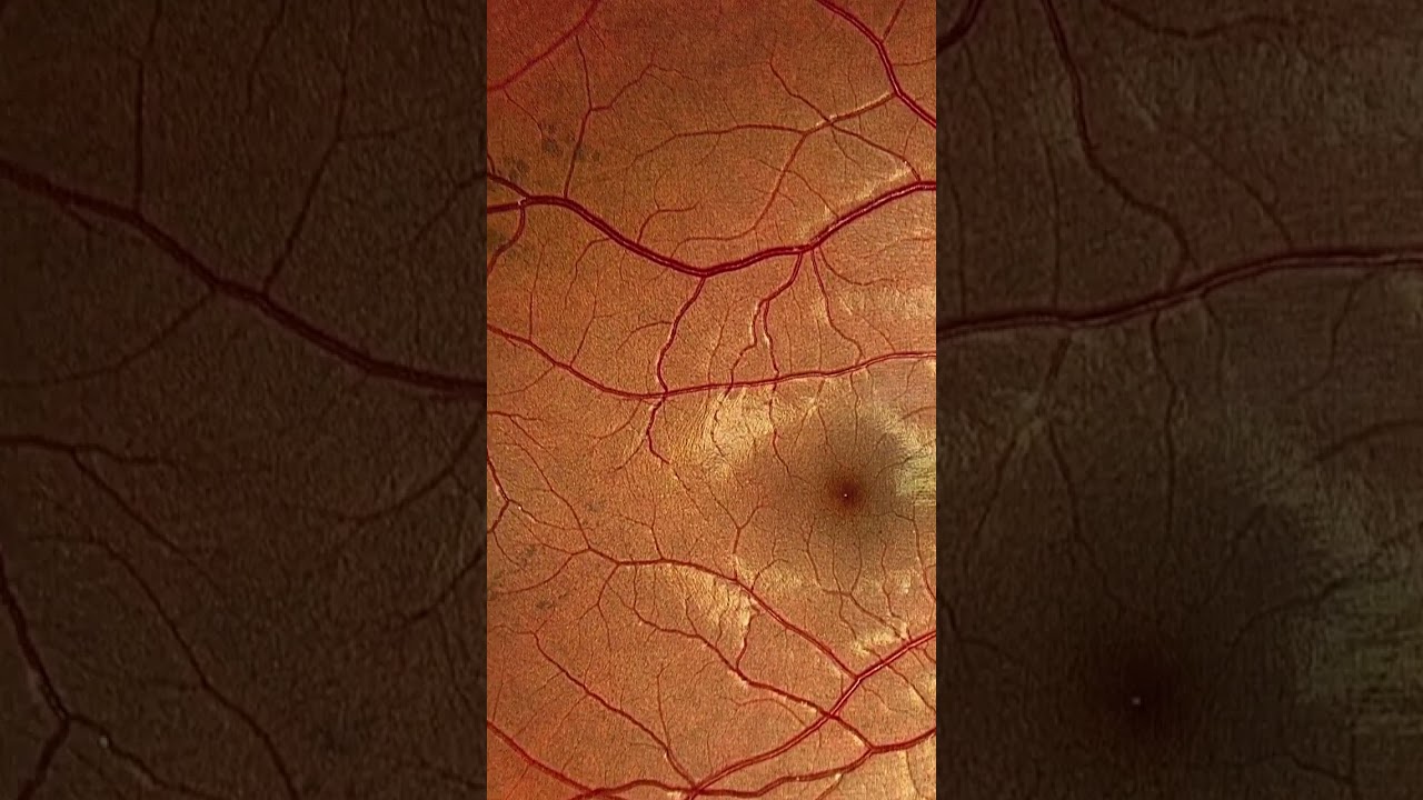 CHRPE (bear track pattern) #retina #oftalmo #ophthalmology #oftalmologia #oftalmología #ophtalmolog