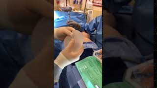 Dr. Reynolds - peri-areolar lift and breast augmentation Pt 8