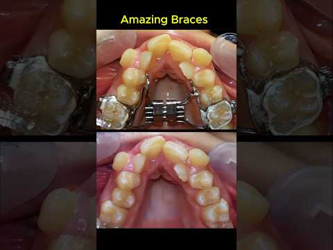 Amazing braces. Fix crowded teeth process #braces #orthodontist #dentist