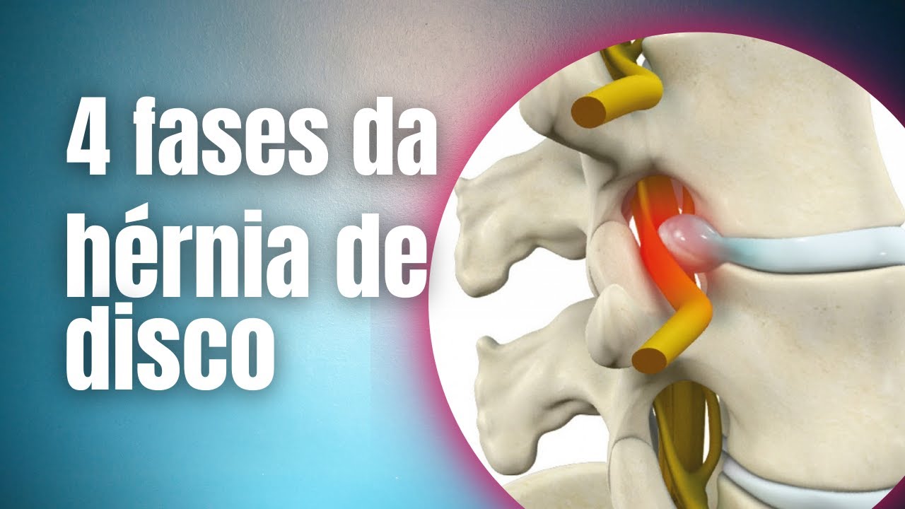 4 fases da hérnia de disco