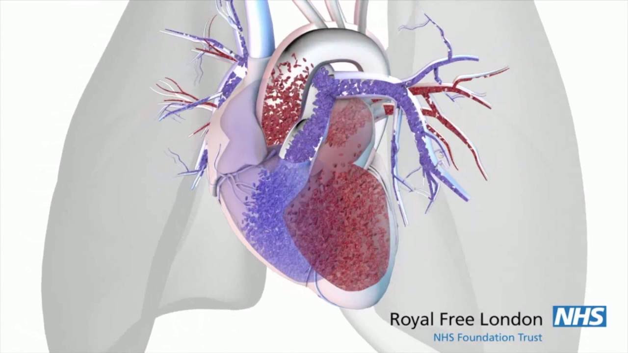 What is pulmonary hypertension