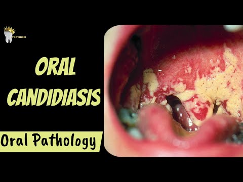 Kandydoza jamy ustnej | Diagnoza i postępowanie | Patologia jamy ustnej