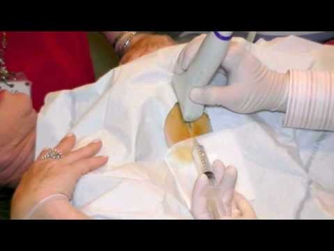 Ultrasound Guided Aspiration - Dan Settle MD