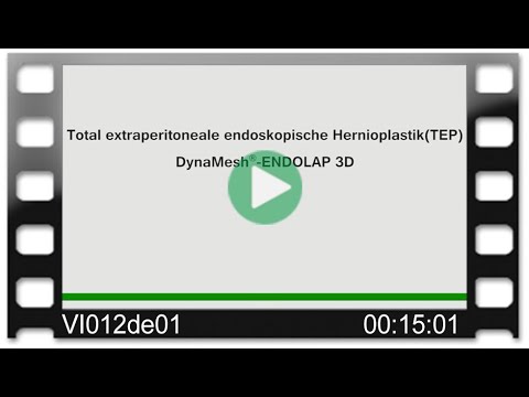 DynaMesh®-ENDOLAP 3D - OP-Video: Total extraperitoneale endoskopische Hernioplastik - TEP