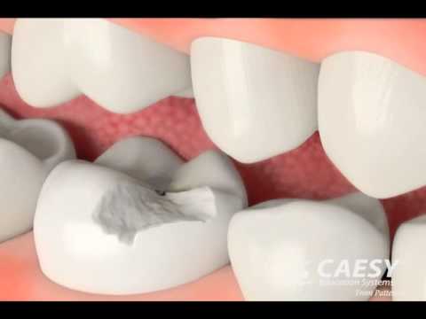 Esthetic Dentistry Indirect Resin Problems With Amalgam