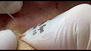 Get ROCK ACNE for lady (P.13) #HoangMySpa194