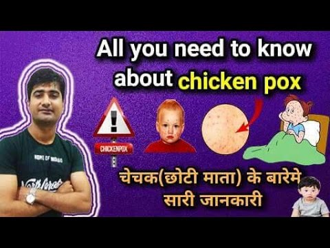 हिंदी -चेचक | छोटी माता | Chickenpox | Symptoms | Treatment | Management | Hindi Video