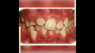قبل و بعد ارتودنسی ثابت | دندانپزشکی سیمادنت
