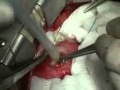 Эхинококк в сердце (операция по удалению червя).flv 