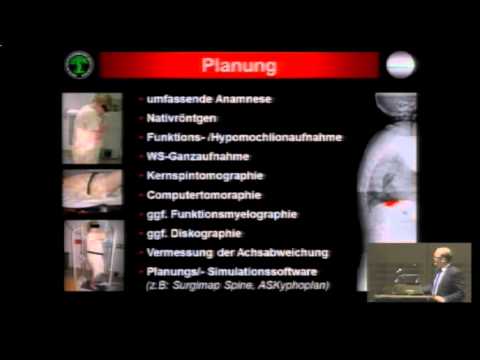 Der Grad der Schädigung der Menisken des Kniegelenkes durch stoller Behandlung von Arthrose und Arthritis des Schultergelenks