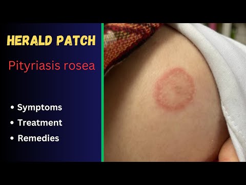 Herald patch | Pityriasis rosea | Causes, Symptoms and Treatment