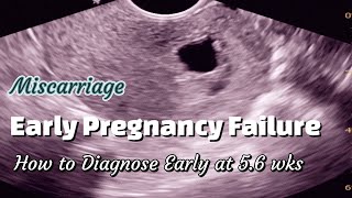 Early Pregnancy Failure - Miscarriage | Ultrasound diagnosis at 5.6 wks