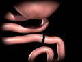 Gastric Bypass Surgery Roux En Y RNY Animated Video