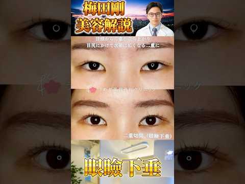 医学科 20代の眼瞼下垂は難しい？！　 #うめだ美容外科クリニック #美容 #眼瞼下垂