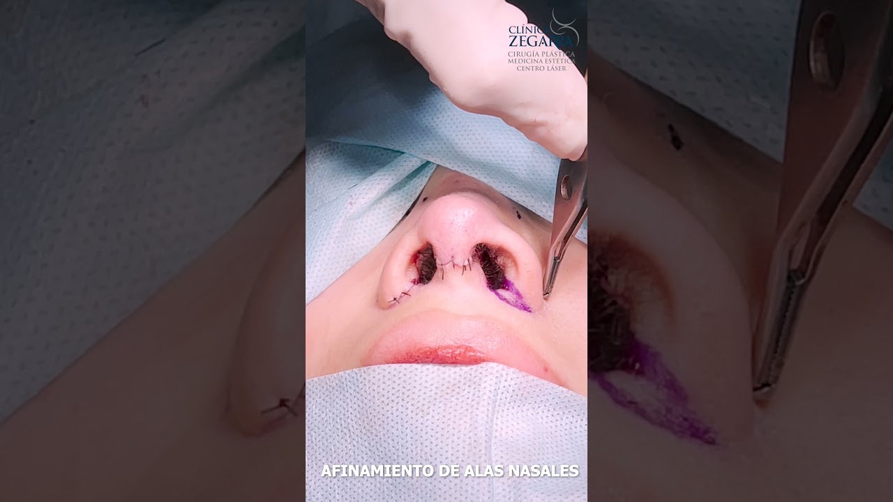 Watch AFINAMIENTO DE ALAS NASALES - DR. FRANK ZEGARRA Now AFINAMIENTO DE ALAS NASALES - DR. FRANK ZEGARRA