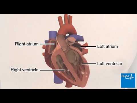 Heart arrhythmias - ventricular fibrillation