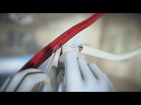 Parachute Vascular Anastomosis - human blood vessel & synthetic graft