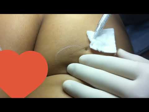 Multilayered injection of calcium hydroxylapatite filler on ischial so | CCID