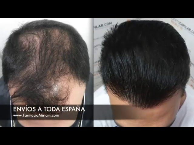Vídeo relacionado con Rueber - Minoelements 60 Ud | Pastillas para el Pelo Anticaida Cabello Mujer y Hombre | Complemento Antialopécico Anticaida Pelo para Crecimiento Cabello Mujer y Hombre | Pastillas Pelo, Piel y Uñas