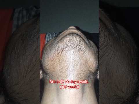 Natural beard growth journey man matters minoxidil beardmax 5% #viralshorts