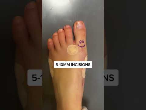 AMI Bunion technique to this foots rescue