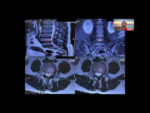 Difference between Modic changes & Hemangioma in vertebral body. Update on How to read MRI of spine