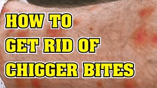 How to Get Rid of Chigger Bites Faster.