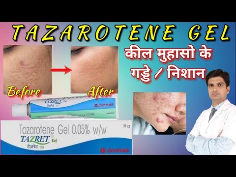 TAZRET FORTE CREAM 0.1% 20GM