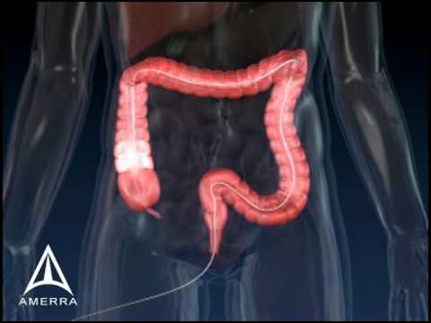 Colonoscopy - 3D Medical Animation