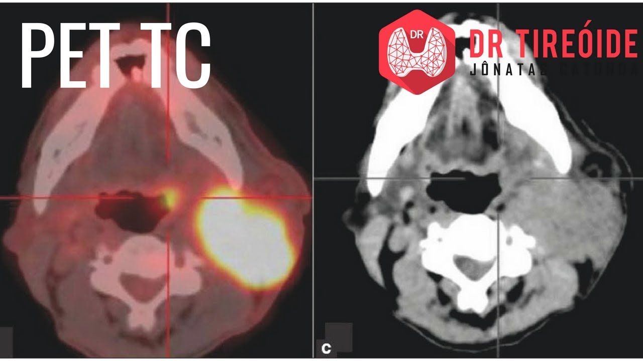 PET ou PET-TC - Entenda como é esse exame e porque ele é tão importante!