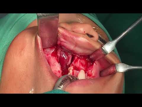 The Bony Defect Inside The Upper Jaw Is Big