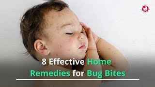 8 Effective Home Remedies for Bug Bites