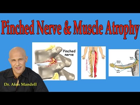 Pinched Nerve and Muscle Atrophy (What You Should Understand) - Dr Mandell