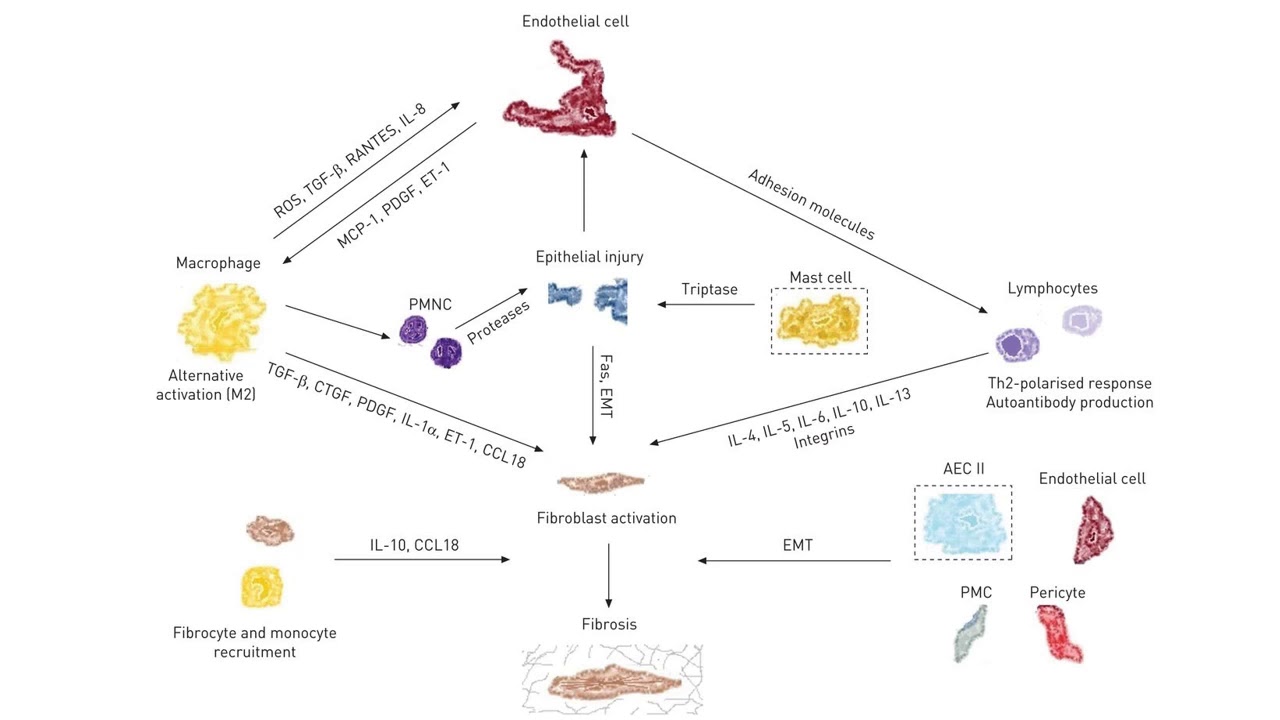 Fisiopatología - Trastornos restrictivos parte 2, Enfermedad pulmonar intersticial difusa (EPID)