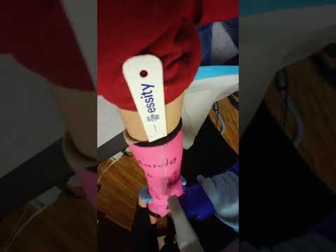 rebroke my arm... part 2