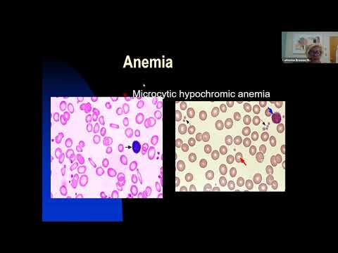 Anemia